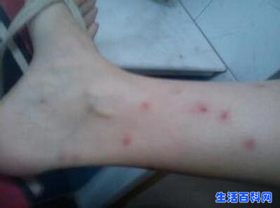 【圖文】跳蚤咬的症狀是什麼?被跳蚤咬的症狀圖片