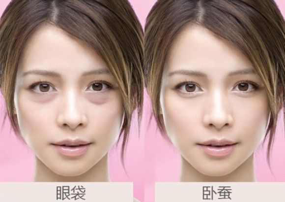 卧蚕和眼袋的区别