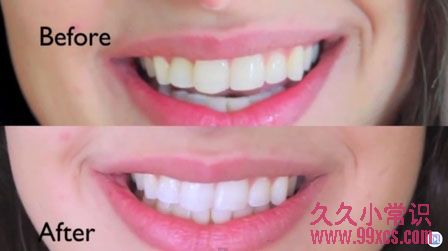 2分鐘快速美白牙齒:簡單居家秘方