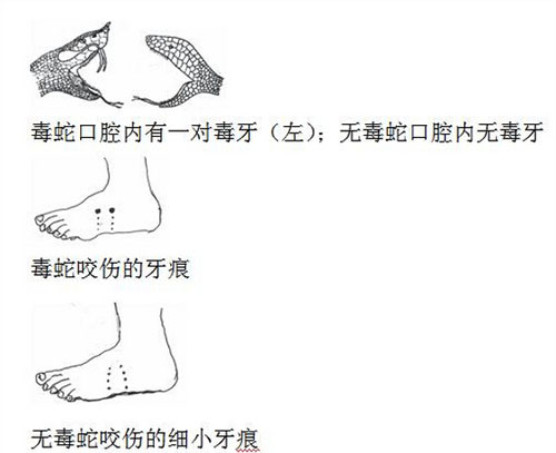 被蛇咬傷怎麼辦？毒蛇咬傷的急救步驟與注意事項