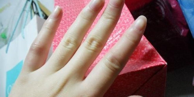 冬天手长冻疮怎么办？如何预防手长冻疮
