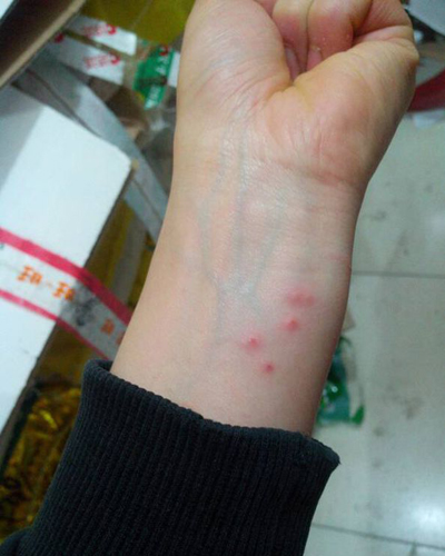 人被跳蚤咬了怎麼辦？四招快速脫困，恢清爽皮膚