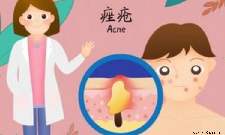 痤瘡與粉刺的區別解析