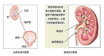 青年人易成結石「最愛」:生活習慣與環境因素解析
