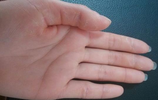冬季脫皮原因解析:手汗多與營養缺乏皆為主因