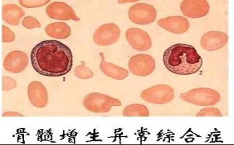什麼是骨髓增生異常綜合征?全面解析發病原因、症狀與預防