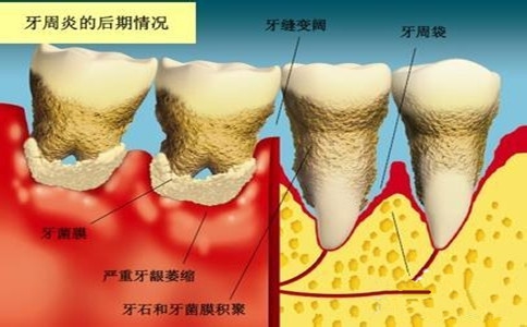 牙周炎可能誘發類風濕關節炎
