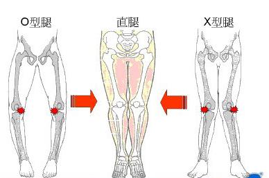 5種走路姿勢會讓你變成O型腿