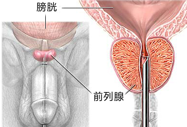 前列腺炎的危害与治疗方法