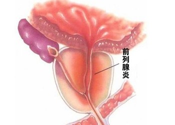 前列腺炎症症状及治疗方法