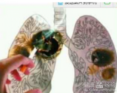 胃癌晚期化疗选择推荐两种治疗方案