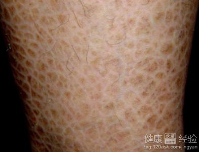皮膚干燥、粗糙、有鱗屑？解析魚鱗病與其他可能原因