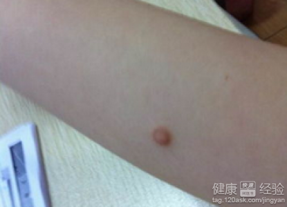 手臂皮肤长肉瘤的原因、检查与治疗建议
