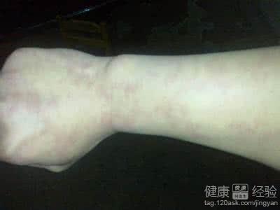 手臂上出现指甲大小的红斑可能是紫癜
