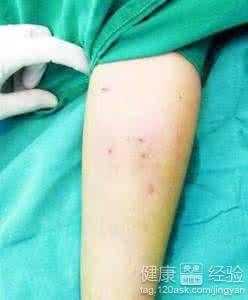 手臂上出现指甲大小的红斑可能是紫癜