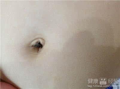 肚臍眼清潔指引：能否使用酒精與正確護理方法