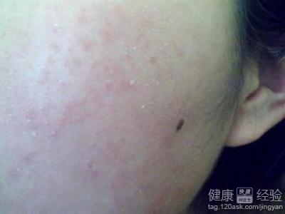 脸部皮肤过敏能用老皮匠草本抑菌乳膏吗？