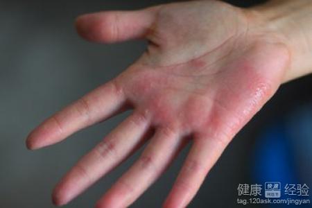 手掌心皮膚粗糙是缺什麼？營養缺乏與症狀對照