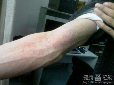 皮膚過敏與水土不服的應對方法