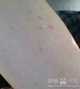 皮膚出現小血點或小紅點（特別是手臂）的原因與應對