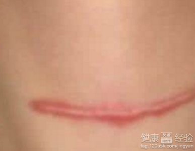 皮肤疤痕怎么解决？三招轻松搞定