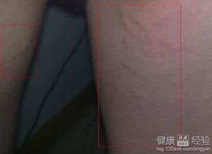 大腿皮肤出现血丝的原因及处理方法