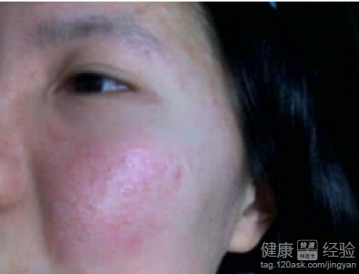 皮膚反覆過敏怎麼辦？緩解與預防步驟大公開