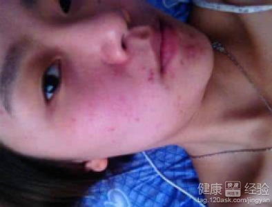 面部皮肤过敏起小疙瘩怎么办