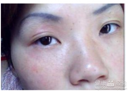 皮膚過敏發炎可以用生理鹽水敷臉嗎？正確做法與注意事項