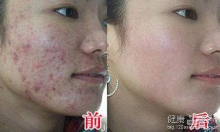 磨皮去痘坑效果如何？会伤害皮肤吗？