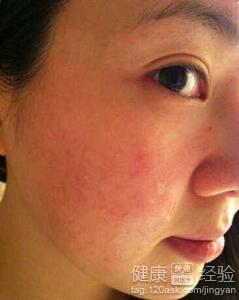 鼻子上增生性痘印能否去除？有效方法解析
