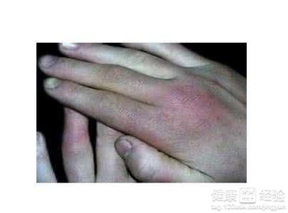 冬季凍傷應對指南：正確處理與預防措施