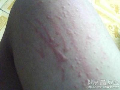 冬季皮膚過敏症緩解指南