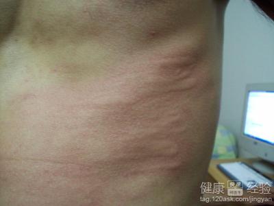 冬季皮膚過敏症緩解指南