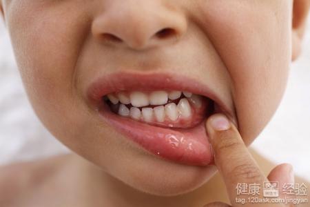 冬季嘴角起泡怎么办？解析嘴角起泡的原因与护理方法