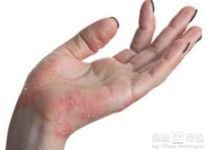 冬季手脫皮原因與預防方法