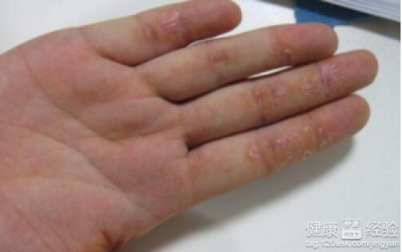 冬季手脫皮原因與預防方法