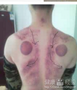 黃道益活絡油按摩後手癘爆皮？正確處理與預防方法