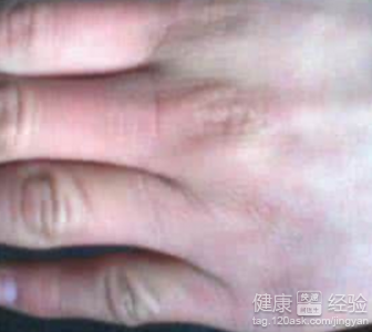 指關節皮膚粗糙按摩與食療:改善關節粗大的方法