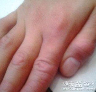 指關節皮膚粗糙按摩與食療:改善關節粗大的方法