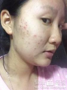 臙上長痘怎麼辦？快讓它好轉的食療小建議
