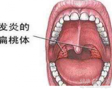 扁桃體反覆腫大怎麼護理？日常調養與預防措施