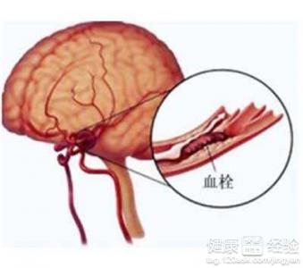 腦血栓飲食注意事項：哪些食物不能吃