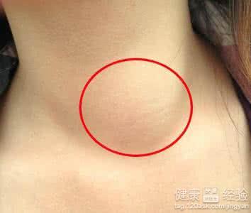 橋本病治療與生活注意事項：飲食、運動與作息指南