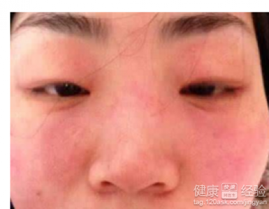 面部皮肤过敏的保养与护理指南