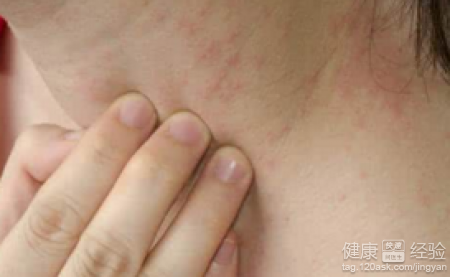 皮炎危害大，饮食搭配需警惕