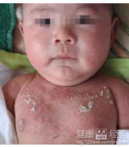 皮炎危害大，饮食搭配需警惕