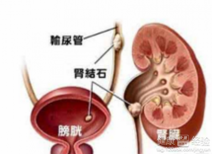 肾结石患者饮食注意事项