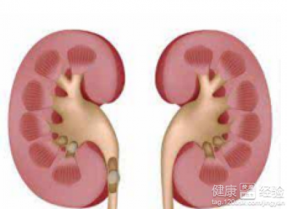 肾结石患者饮食注意事项