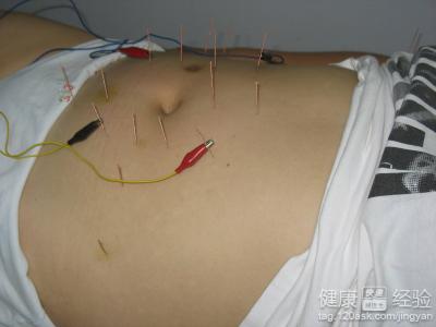 针灸减肥有效吗？针灸减肥穴位与效果全解析